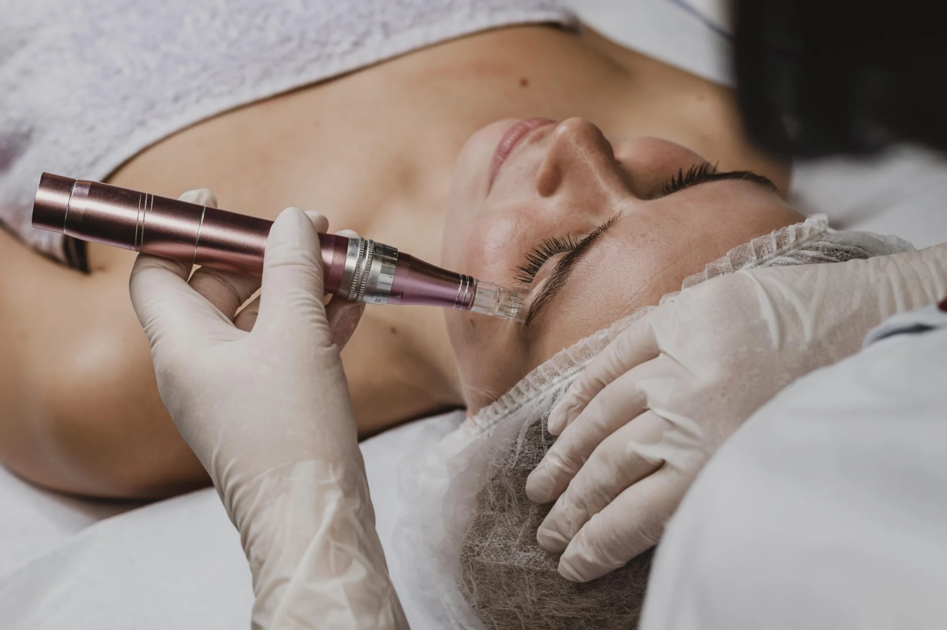 Why Microneedling works in Treating Acne Scars