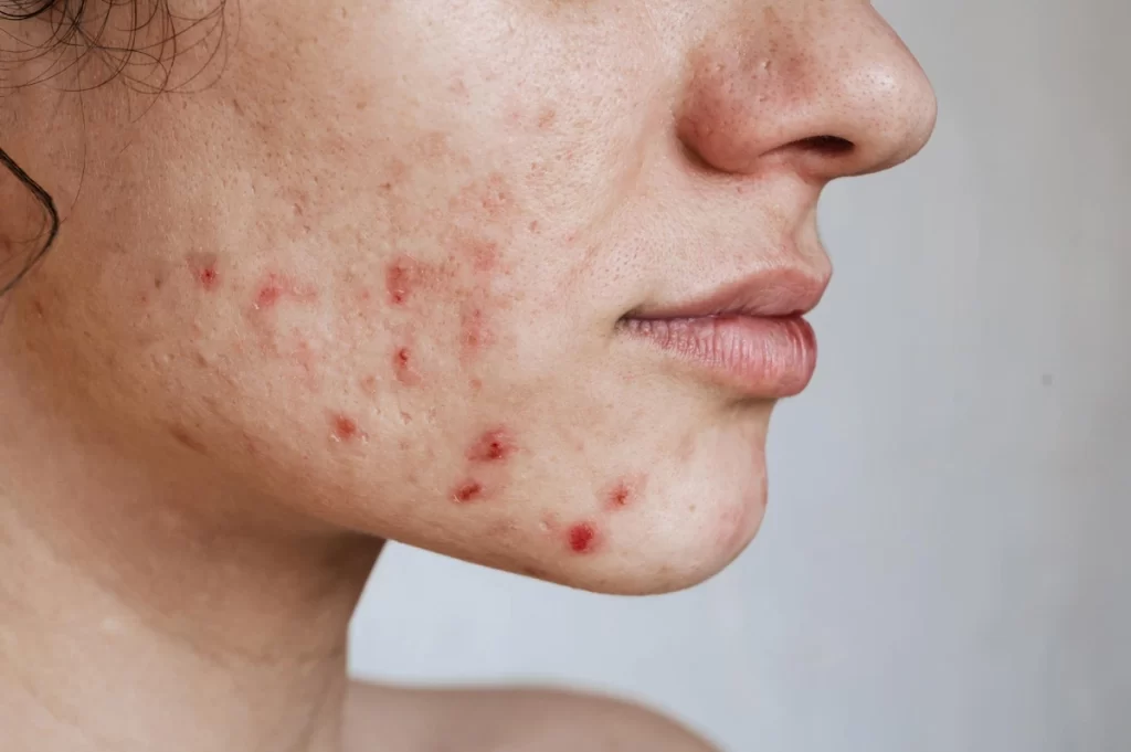 acne scars treatment