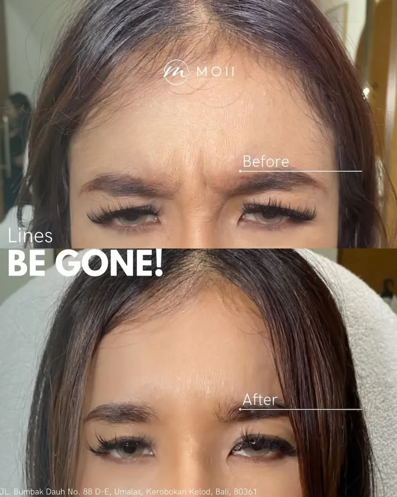 Before & After Botox in Bali