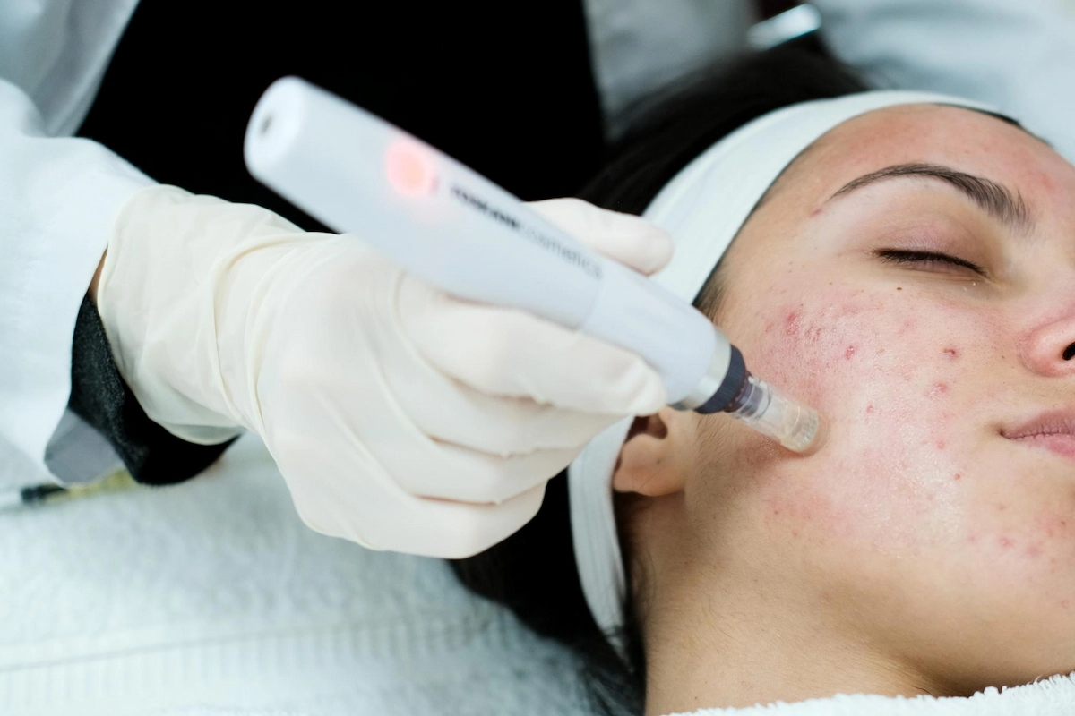 RF microneedling