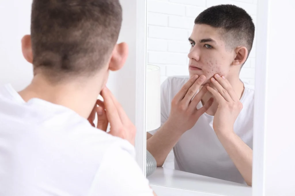 acne treatment for sensitive skin