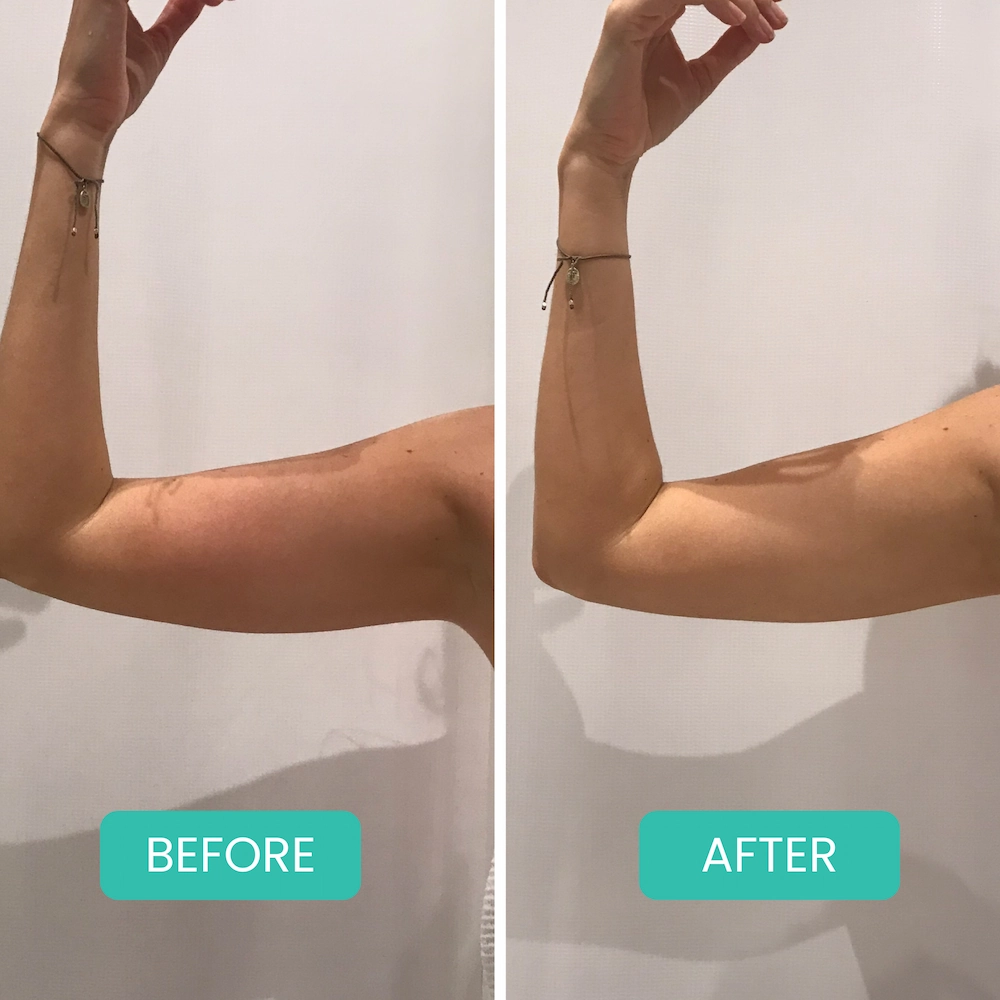 Before and After Emsculpt in Bali at MOII Aesthetic Clinic