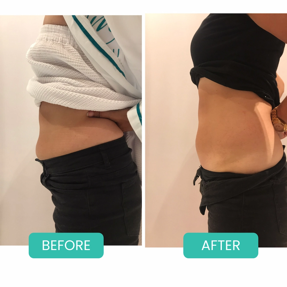 Before and After Emsculpt in Bali at MOII Aesthetic Clinic